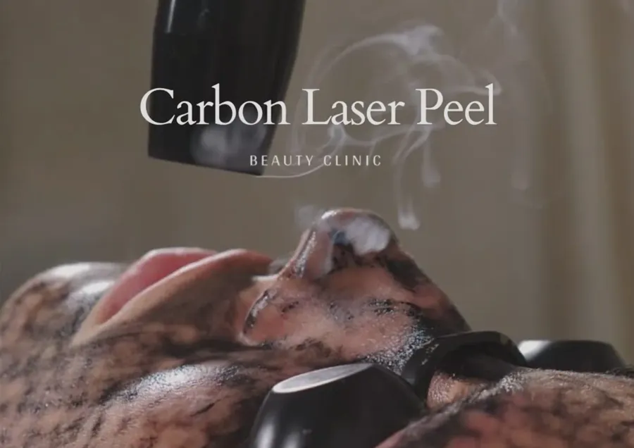 Carbon Laser Peel
